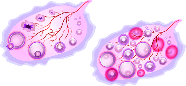 Schéma des Ovaires micropolykystiques symbolisant le fait que la fertilité peut être altérée